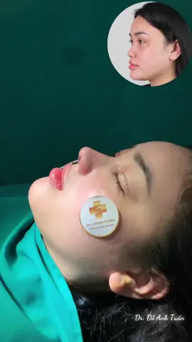 Đã có chiếc mũi đẹp đón tết 💯❤️#nangmuicautruc #catmi #lamdepantoan #tutintoasang 