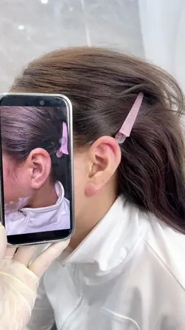 Siêu phẩm cứ tiêm là ra tai#ThưThưBeauty #tiêmfillerphanthiết #tiêmviềntai 