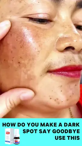 Yy Clean faces are always easier to like, so get rid of those freckles#skincare #foryou #spots #aobenz #fyp 