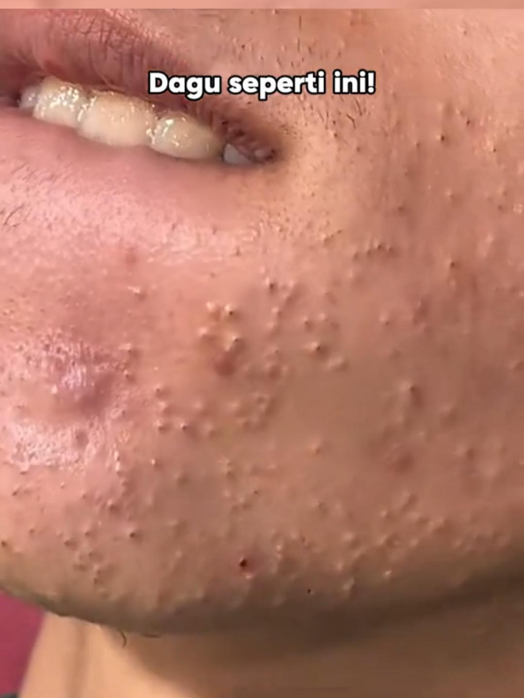 //-Pori-pori terasa sumpek dan penuh minyak? 😫 Coba ZIADOO Mud Mask! 🤩 Ini bakal nyedot semua kotoran dan minyak berlebih, bikin kulit bersih dan lega! ✨ #cleansing #ZIADOO #ziadoo #ziadooid #skin #tiktok #SkinCareMustHave #claymask #oilyskin #pores #fyp