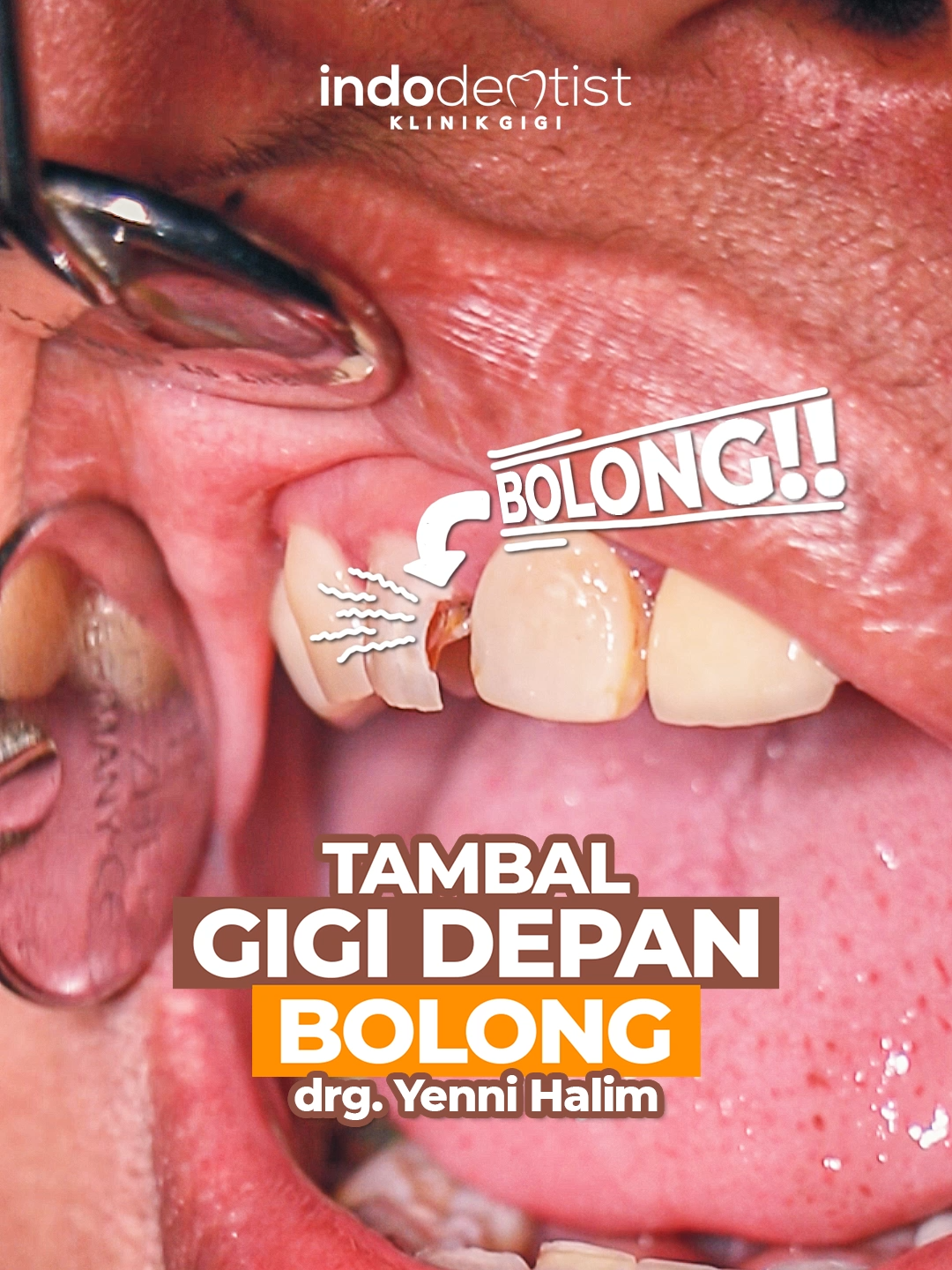 Penambalan gigi depan bolong dan keropos, oleh drg. Yenni Halim. . . Appointments: -Joglo: 0811919176 -Tangerang: 087888280088 . . #klinikgigijakarta #indodentist #klinikgigijakartabarat #doktergigijakarta #dentaljakarta #dentalklinik #fypage #fyp #tambalgigi #tambalgigidepan #tambalgigiestetik #gigidepan