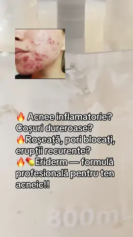 Acnee inflamatorie, coșuri dureroase sau pori blocați? Eriderm Apothek este formula profesională creată pentru ten acneic, erupții recurente, roșeață și inflamație. Textura ușoară acționează rapid, reduce disconfortul local și ajută la curățarea pielii în profunzime. Conține ingrediente cu rol antibacterian + exfoliant: • Eritromicină – acțiune intensă pe leziuni active • Peroxid de benzoil – curățare profundă & prevenirea erupțiilor noi • Bază Fagron – hidratare echilibrată, fără efect gras ✔ pentru acnee inflamatorie ✔ pentru coșuri dureroase și roșeață ✔ pentru ten gras, mixt sau predispus la erupții ✔ ajută la uniformizarea și calmarea pielii Eriderm — îngrijire profesională, concepută pentru un ten mai curat și mai uniform. #acnee #cosuri #ingrijireatenui #skincare #eriderm 