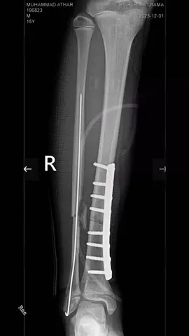 Cepat sembuh, tayy! Kami semua di sini mendoakan kesembuhanmu dan tidak sabar melihatmu kembali beraktivitas dengan senyum cerahmu.#mathar23 #fansatay #fyppppppppppppppppppppppp 