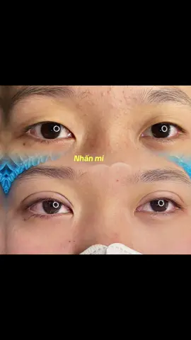 Nhấn mí vừa xong #mắthaimí 