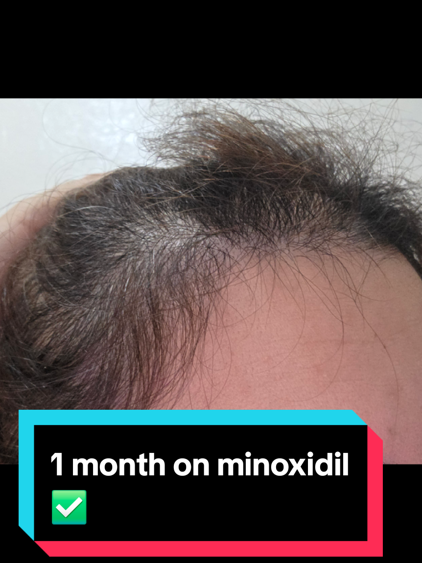Am deja o luna si o săptămână de cand folosesc minoxidil derma roller laser si injecție in scalp cu exosome!pasi mici dar se vede ceva!aparte vitaminele sampoanele etc!#alopeciaandrogenetica🙃 #minoxidil 🔥##treatment🍾 #exosome ♥️#alopeciafighter✅️