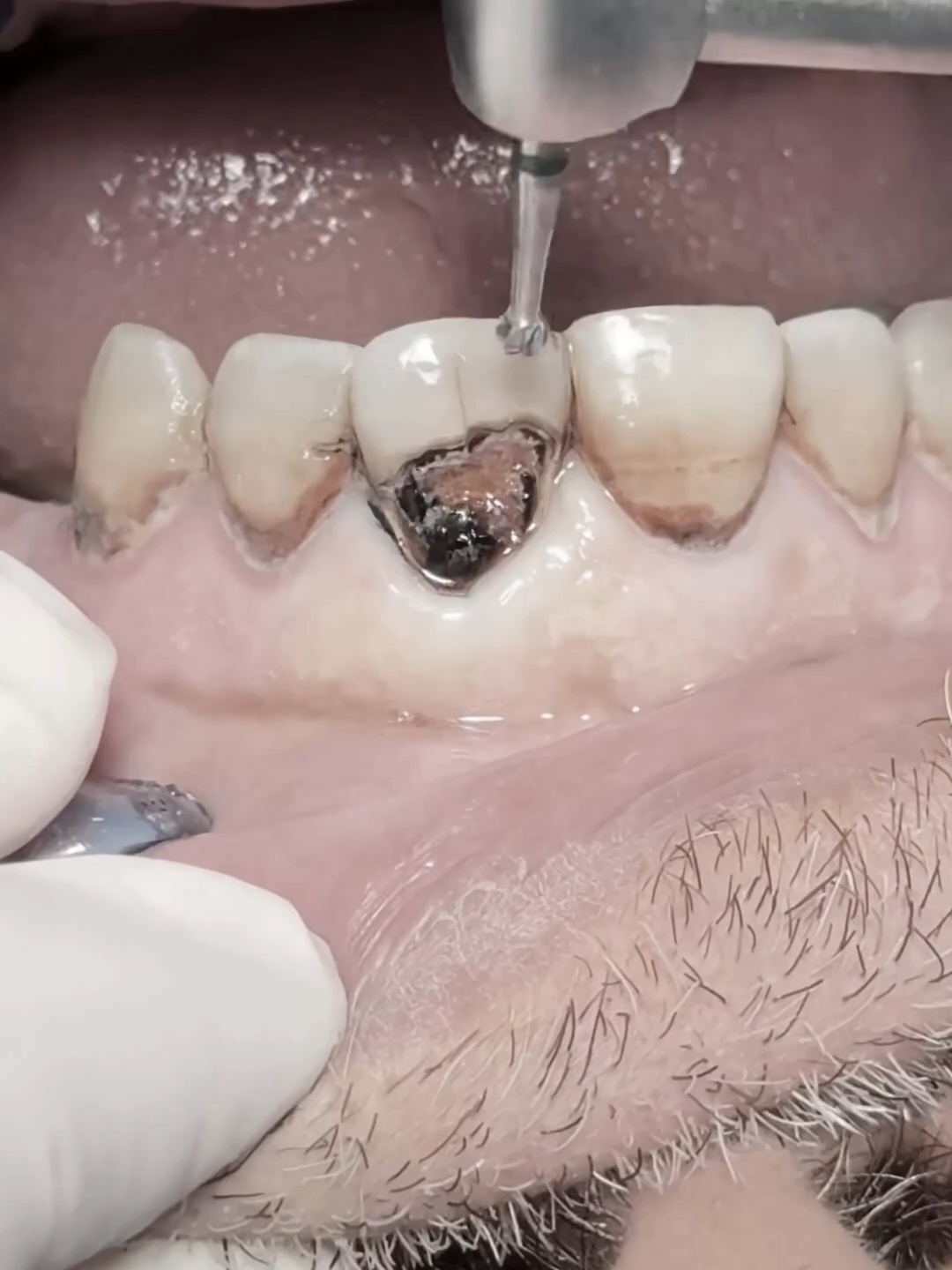 Root canal treatment & composite veneer for central incisor deep labial cavity #dentist