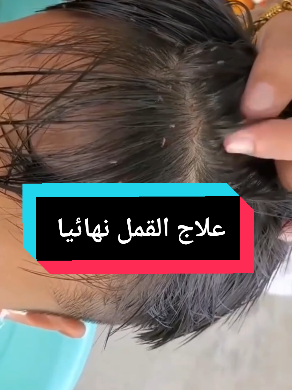 الوصفة المنقذة علاج قمل الشعر نهائيا و للأبد👌✅ #اكسبلور #foryoupage❤️❤️ #fyp  #قمل #lice 
