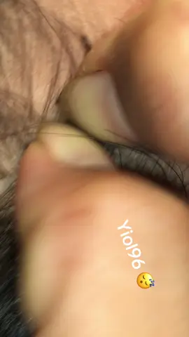 Remove lice #omg🙀🙀🥶🥶🥶😱❤️❤️ #lice #liceremoval 