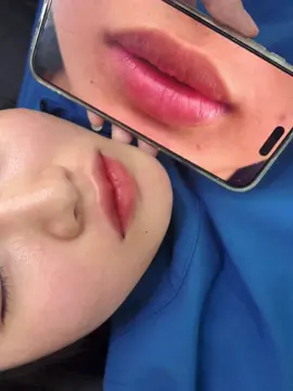 Cắt môi đẹp tại Bắc Ninh #xh #bacninh #catmoi #cắtmoidep #sửamoiloi 