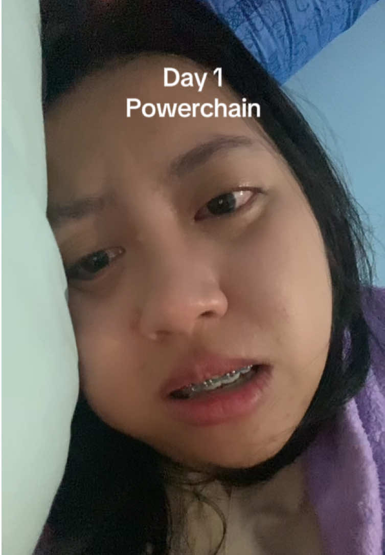 Bagian 129 | 😭 #fyp #fypage #powerchain #behel #orthodontics 