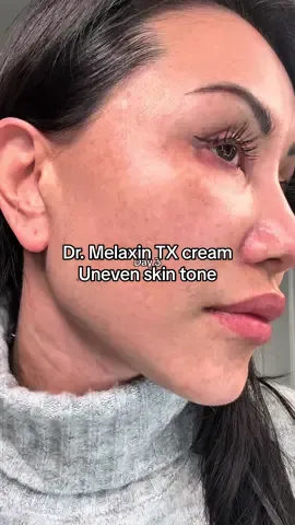 Uneven skin can be supported with @Dr.Melaxin Global tx cream. Use nightly before bed. Apply spf 50 during the day and avoid direct sunlight to the face.  #tiktokcreatorpicks #koreanbeauty #skincareroutine  #kbeauty #healthandwellnessdeals