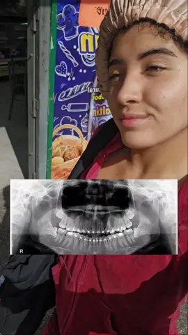 #creatorsearchinsights Mi experiencia sacándome las cordales en Caracasss ✨️ #cordales #operaciondecordales #odontologia #muelasdeljuicio 