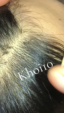 Remove lice #😱😱😱omg #😂😂😂 #lice #🥶🥶🥶 #🥶🥵 