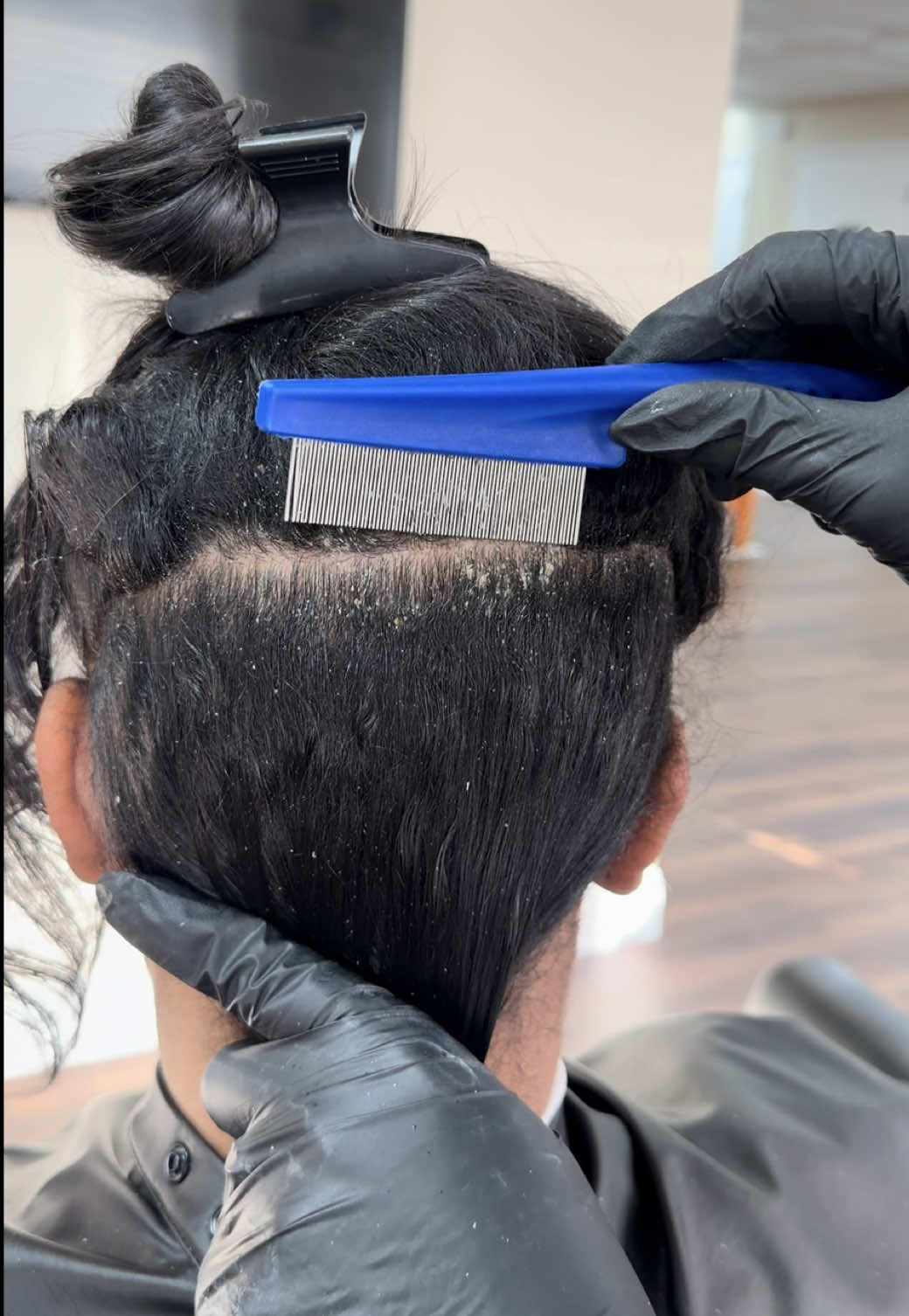 Light Detox 💆🏽‍♀️ This is literally one of my favorite services to do. Notice how the scalp isn’t irritated or bleeding. It’s all in the technique and a safe gentle removal of flakes. 😌 My clients feel instant scalp relief every time. 🤎 #scalpcare #fyp #dandruff #scalphealth #healthyhair 