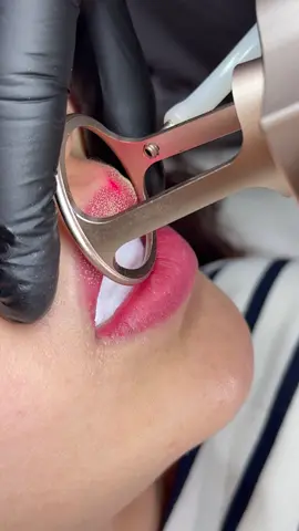 Ngày nào cũng có 2-3 ca Co2 môi liềnn #co2fractional_laser 