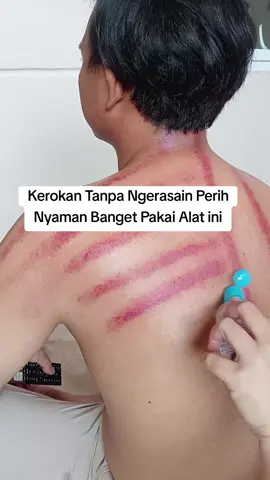 #AlatKerokan #AlatBekam 