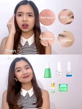 Last year me wouldn’t believe my current skin condition looks like🥹 #skinproblem #skincaretips #skinconcerns #acneproneskin #skincareproducts #biobeautylab 