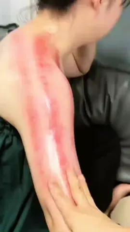 #alatwajah #alatbekam #alatkerokanmasukangin #alatkerok #kerokan 