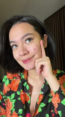 no acne no stress no drama 😭 mari kita usahakan kulit mulus itu 🪄 #noacnenodrama #serumjerawat #acnezonemsglow #msglowbeauty #jerawat 