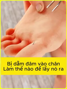 ⚠️Chân bị dằm? Đừng hoảng, làm theo 3 bước này là “ngon” ngay!😎 #ChămSócVếtThương #MeọHay #AnToànSứcKhỏe #sốngthôngminh 
