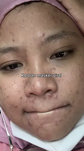 Korban pake skincare viral🥹☝🏻 #acnebestie #Bigjargelmask #acnaway 