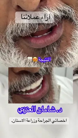 آراء عملائنا تتكلم ..وخبرة الدكتور باينه م يحتاج لها شرح .🩺 د. شامان العنزي 🩺🦷 #زراعة_اسنان #عيادات #اكسبلورexplore #دكتور #جدة 
