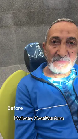 Over Denture delivery ✨. #CapCut #dentist #smile #storytime #mady 