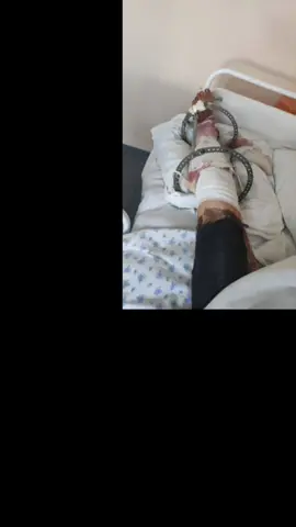 #КажетсяАмпутация#Ампутацияноги#протезированиеноги#протез 