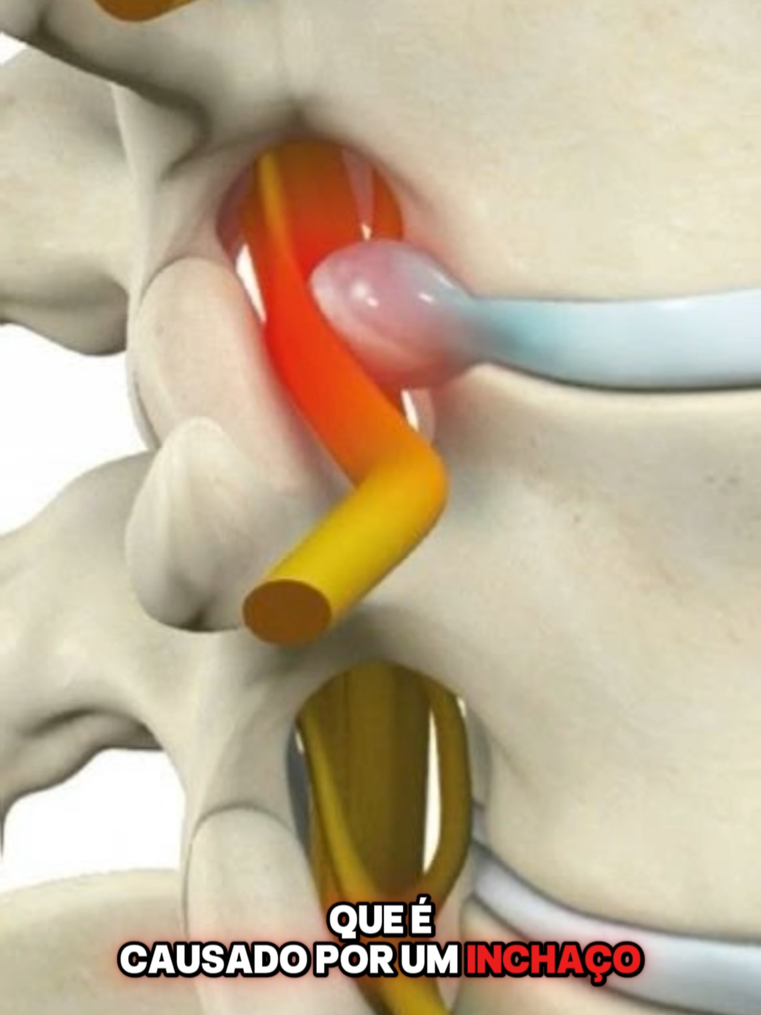 #coluna #dornascostas #dornacoluna #dornalombar #colunatravada #colunavertebral #semandar #dor #escoliose #cirurgia #cirurgianacoluna #doresnascostas #quiropraxia #fisioterapia #medico #hospital #internação