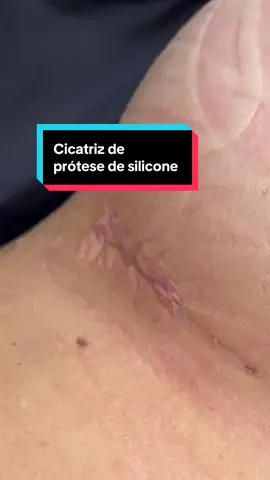 Cicatriz com 8 dias de evolução. Prótese de silicone.  #protesedesilicone #cirurgiaplastica #cirurgiaoplastico #mamoplastia 