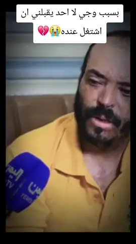 بسبب وجهي لااحد يقبلني ان اشتغل عنده#حسبي_الله_ونعم_الوكيل_💔💔💔😢😢😢 #متابعه_ولايك_واكسبلور_احبكم #اكسبلور #livefest2025 #اليمن🇾🇪المملكة🇸🇦 