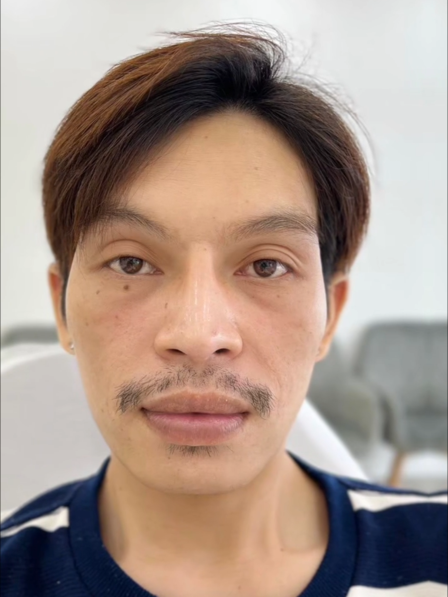 จากสิวอักเสบ–รอยแดง–รอยดำเต็มหน้า สู่ผิวใสขึ้นแบบ เห็นได้ด้วยตาเปล่า ✨ เพราะผิวที่ดี…ทำให้ความมั่นใจกลับมาเสมอ ขอบคุณรีวิวจาก “คุณเก๋ รุ่งนภา” ผู้บริหารศูนย์ฯ สะโรรักษ์ ทั้ง 8 สาขา 💚 #สะโรรักษ์ #พอกสด #สมุนไพรพอกสด #ลอกหน้า #พอกสดสะโรรักษ์