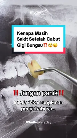 Kadang abis cabut gigi bungsu, rasa sakit bisa bertahan cukup lama! Bahkan bisa sampe berminggu-minggu! 🫣 Ada yang lagi ngalamin?  #cabutgigi #cabutgigibungsu #gigibungsu #impaksigigi #sakitgigi 