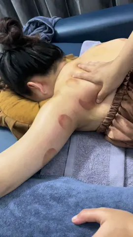 Đau cổ vai gáy - nguyên nhân khiến tay tê bì, yếu lực. Bạn có biết ? Khi vùng cổ vai gáy bị căng cứng, cơ và dây thần kinh quanh đốt sống cổ sẽ bị chèn ép, khiến khí huyết lưu thông xuống cánh tay kém. Hậu quả là tay dễ bị tê bì, mỏi yếu, đặc biệt khi ngồi lâu, làm việc với máy tính hay dùng điện thoại nhiều. — Giải Pháp Hiệu Quả: - Thư giãn, massage trị liệu cổ vai gáy giúp giải phóng chèn ép. - Kéo giãn cơ nhẹ nhàng, tăng lưu thông khí huyết. - Duy trì tư thế đúng và nghỉ ngơi hợp lí. Chăm sóc vùng cổ vai gáy sớm - để đôi tay luôn linh hoạt và khoẻ mạnh mỗi ngày. Ibox để Kim đặt lịch chăm sóc bạn nhé! #trilieucovaigay #massage #massagetanphu #massagetherapy #massagecovaigay 