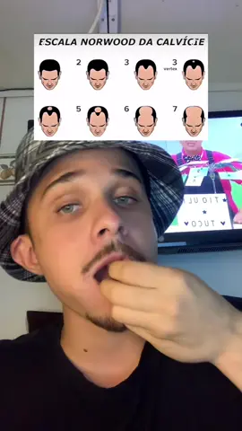 #quedadecabelo #calvo #calvicie 