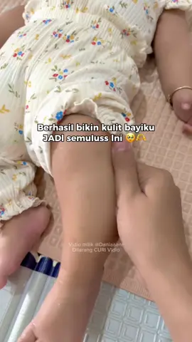 masyaAllah bekas Iuka gigitan nyamuk peIan-peIan iIanggg 🥹🫶  #bebio #bebiobabyserum #babyserumbebio #krimbayi #kulitbayi 