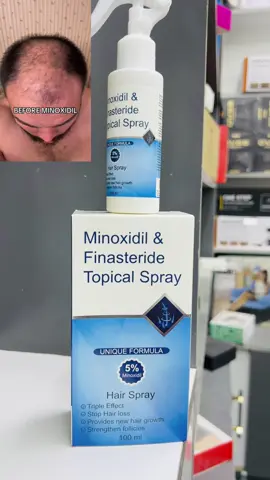 #minoxidil #muqdishotiktok #tiktok #kismayotiktok #fyp 