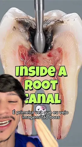 Procedimento de Canal dentário incrível #canaldentario #canal 