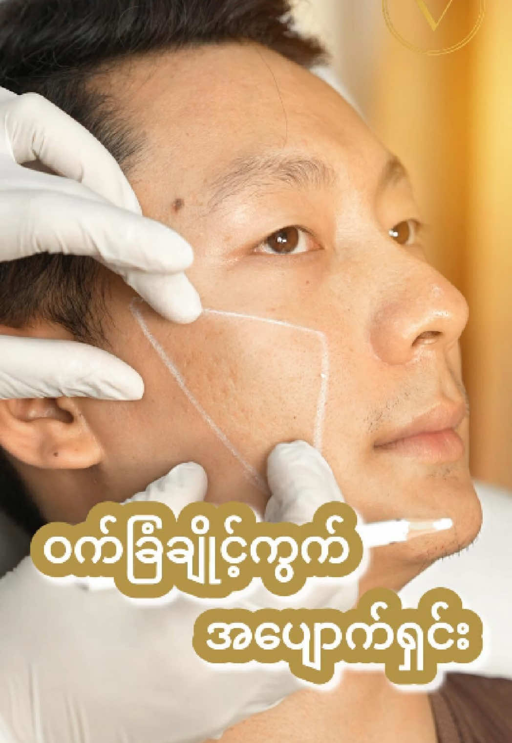 ချိုင့်ကွက်တွေကို အပျောက်ရှင်းဖို့ လုပ်ပေးဖြစ်တဲ့ ကုသမှုလေးပါ။  #ဝက်ခြံချိုင့်ခွက် #scar #treatment #beauty #lvclinic 