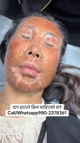 #muser #foryou #viral #scar #burnt 