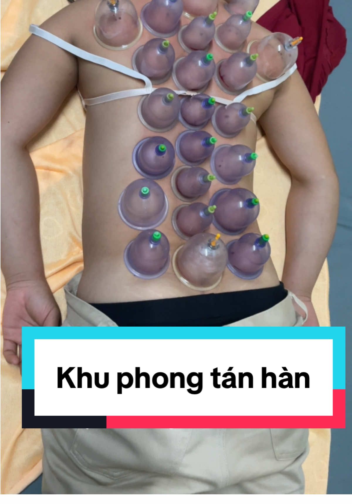 Khu phong tán hàn bằng giác lể #phonghàn #giáchơi 