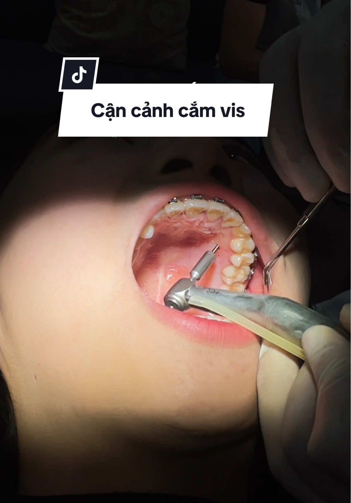 Sợ nhất là cắm vis nhưng k sợ bằng nụ cười không ưng ý. Nhất định làm tới cùng, tới khi nào đẹp thật thì mới tháo niềng hehe #xuhuong #trinhniengrang3119 #niengrang #braces #ortal 