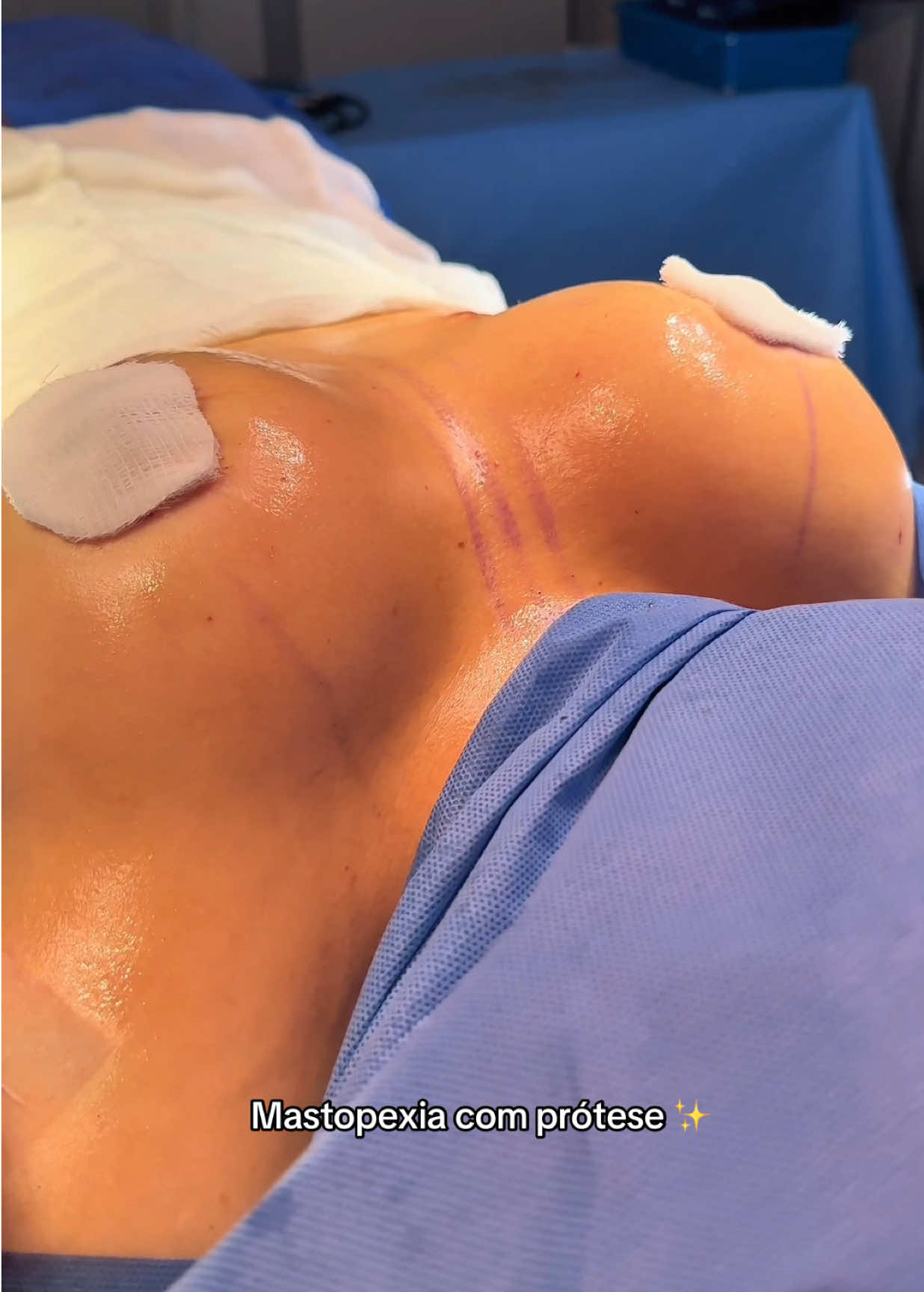 #cirurgiaplastica #dricarosamuel #lipohd #foryou #fyp 