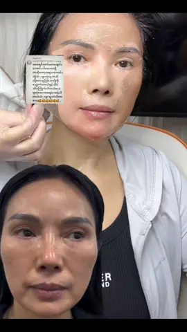 #brတင်းတိတ်ပျောက်ဆေး #ထောပတ်သီးတင်းတိတ်ပျောက်ဆေး #fyppppppppppppppppppppppp @Mal Thidar @Angel Smart Person @Malthidar(တင်းတိတ်ပျောက်ဆေး) @Ma Thi @malthidar(တင်းတိတ်ပျောက်ဆေး) 