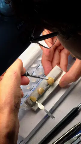 A Ferreira Amaro Dental Lab é um laboratório de próteses especializado em porcelana, com unidades em Goiânia e Porto Alegre. Trabalhamos com facetas de porcelana, lentes de contato dental, próteses fixas, reabilitação oral, fluxo digital CAD/CAM e escaneamento intraoral. Toda a produção passa por frezadoras e impressoras 3D de última geração, garantindo precisão e agilidade. Atendemos dentistas de todo o Brasil com um processo digital completo, pensado para entregar estética, previsibilidade e resultados de alto nível. #dentallab #dentallaboratory #facetas 