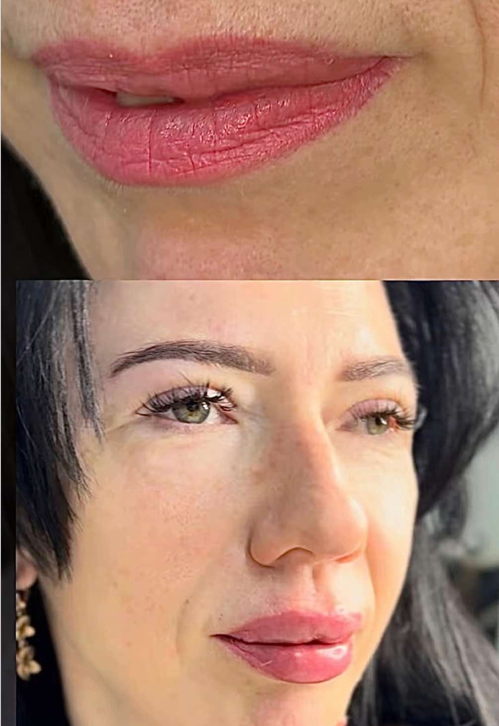 Хотите губы красивые?-есть у каждого человека скрытые желания ,он их не говорят вслух..Коррекция и скрытые несовершенства (через пару дней отек с верхней губы сойдет) Дистальный прикус-это разновидность нарушения смыкания зубов, при котором верхняя челюсть сильно выдвинута вперед. Такое состояние считается аномалией окклюзии, потому что оно нарушает гармонию лица и работу зубочелюстной системы. #косметологшымкент #губы #доипосле #ботокс #косметология 