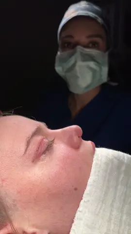 Revision Rhinoplsty🔥 . . . . #revisionrhinoplasty#revizyonrinoplasti#rhinoplasty#barnienose#rinoplasti