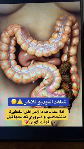 #قولون_معدة_غازات_إنتفاخات_إمساك_حموضة #الرياض_جده_مكه_الدمام_المدينه #الرياض❤️ #قولون_العصبي #قولون_هضمي 