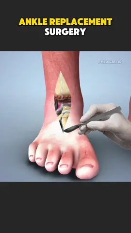 Ankle Replacement Surgery (3D Animation) #anklereplacement #totalanklereplacement #anklearthritis #anklejointsurgery #anklesurgery 