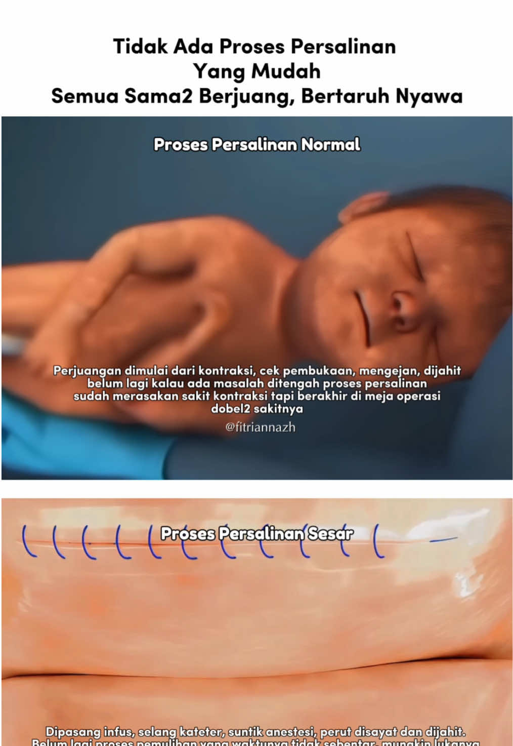 Melahirkan normal / sesar semua ibu tetaplah ibu yang hebat 🤍❤️ #persalinan #melahirkannormal #persalinannormal  #melahirkancesar #persalinansesar 